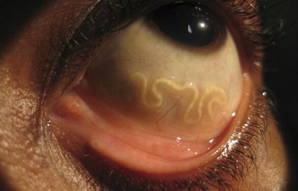 Loa Loa tārps dzīvo cilvēka acī un izraisa aklumu